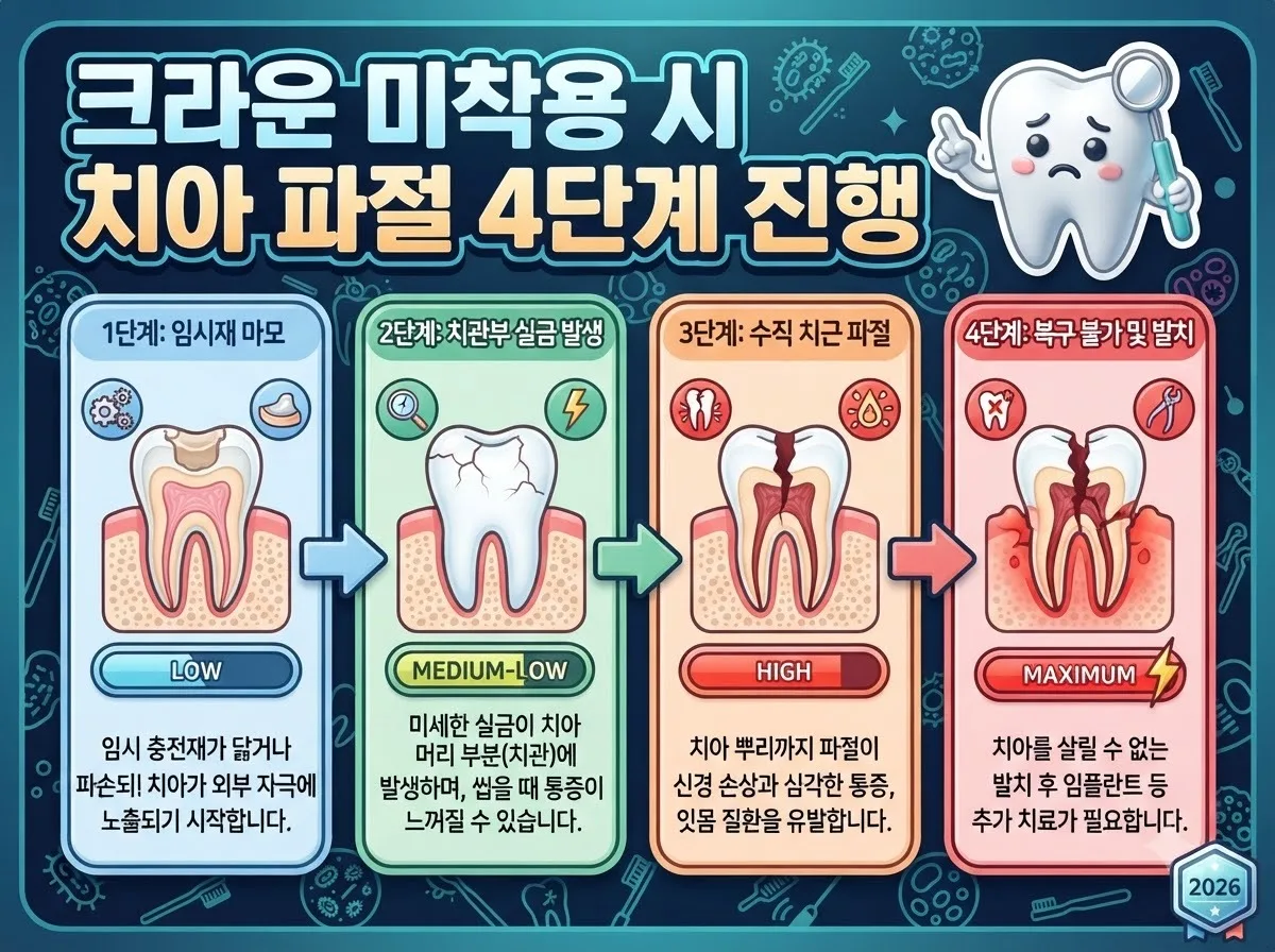 신경치료 후 크라운을 씌우지 않았을 때 임시 충전재 마모부터 수직 치근 파절과 발치로 이어지는 4단계 악화 과정을 나타낸 안내도